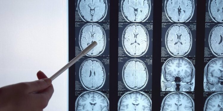 Di Battista e il tumore al cervello, in Italia circa 6mila diagnosi ogni anno: quali sono i sintomi ‘spia’