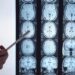 Di Battista e il tumore al cervello, in Italia circa 6mila diagnosi ogni anno: quali sono i sintomi ‘spia’